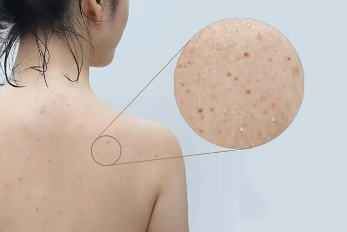 Trị viêm nang lông · Lưng - Tay - Chân